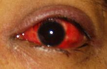 Conjunctivitis